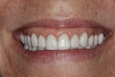 Patient teeth close-up after reconstruction