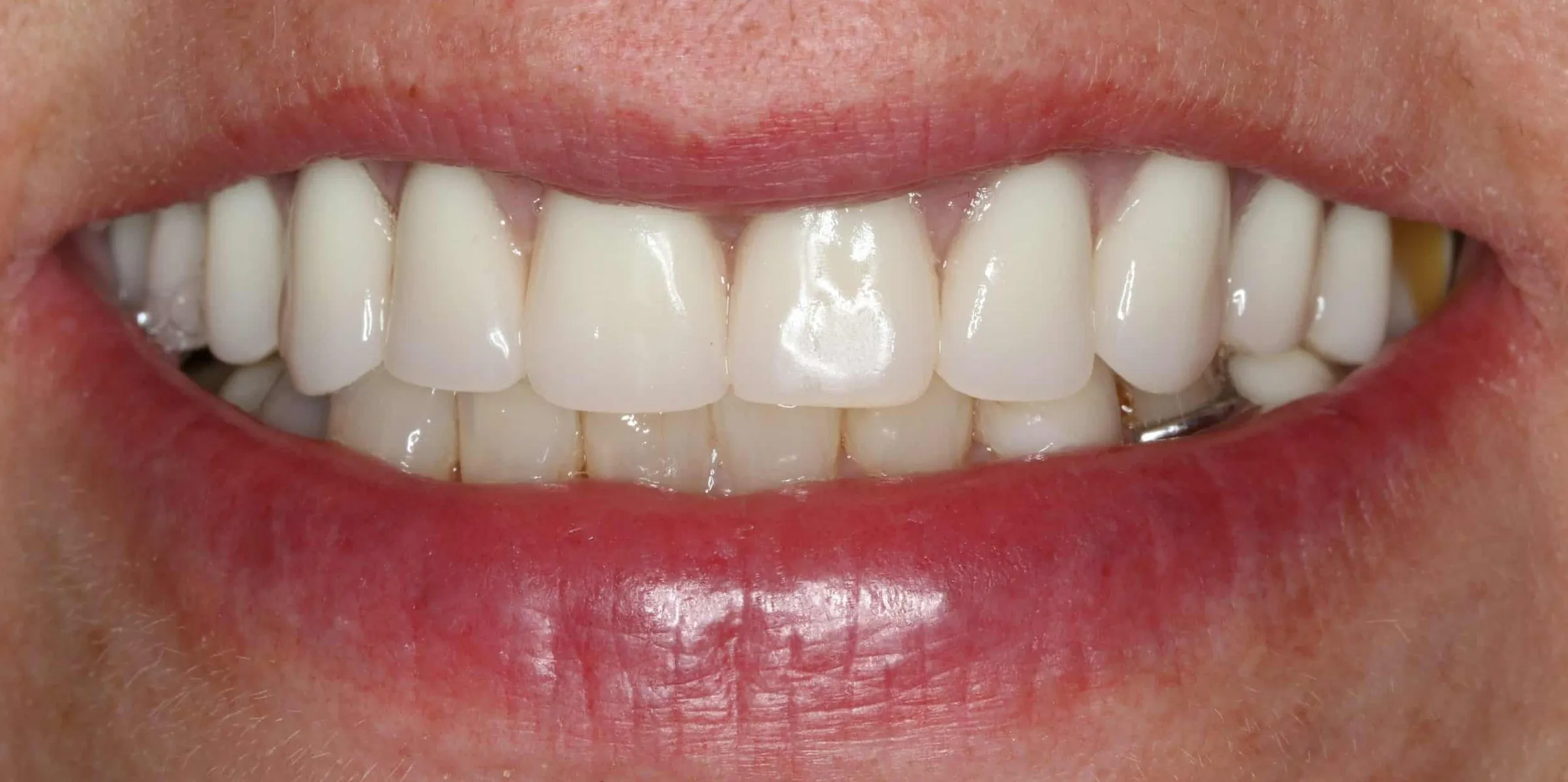 Linda's smile after treatment - portrait