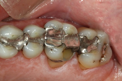 before reconstructive dentistry on back teeth
