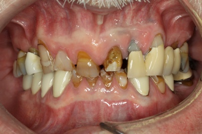 close up view of male dental patient before Dr. Brisman was able to fix his smile