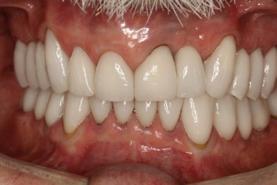 close up view of male dental patient after Dr. Brisman was able to fix his smile