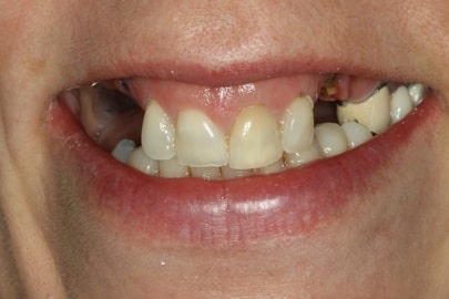 closeup of teeth before being transformed with dental implants