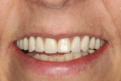 closeup of teeth transformed with dental implants